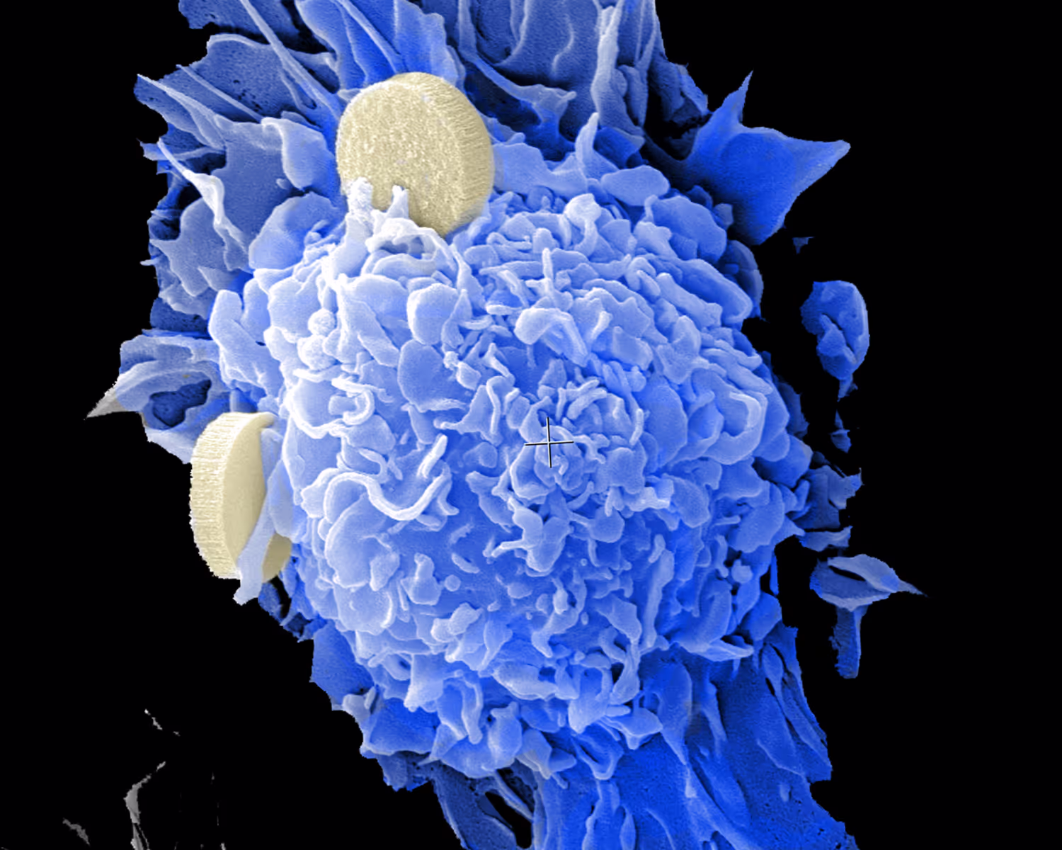 Cellule cancéreuse phagocytant des nanoparticules